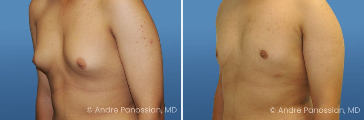 Male Breast Reduction (Gynecomastia) Before & After Gallery - Patient 235630 - Image 2