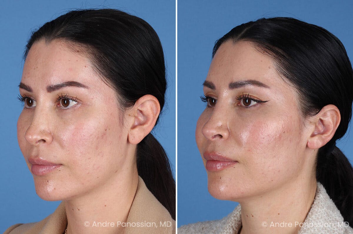Ear Pinning (Otoplasty) Before & After Gallery - Patient 227974 - Image 4