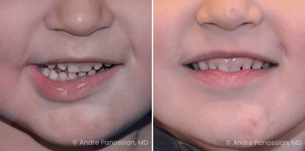 Symmetry Procedures Before & After Gallery - Patient 178090 - Image 1