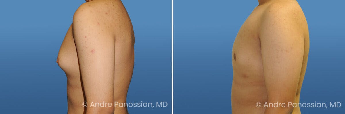 Male Breast Reduction (Gynecomastia) Before & After Gallery - Patient 235630 - Image 3