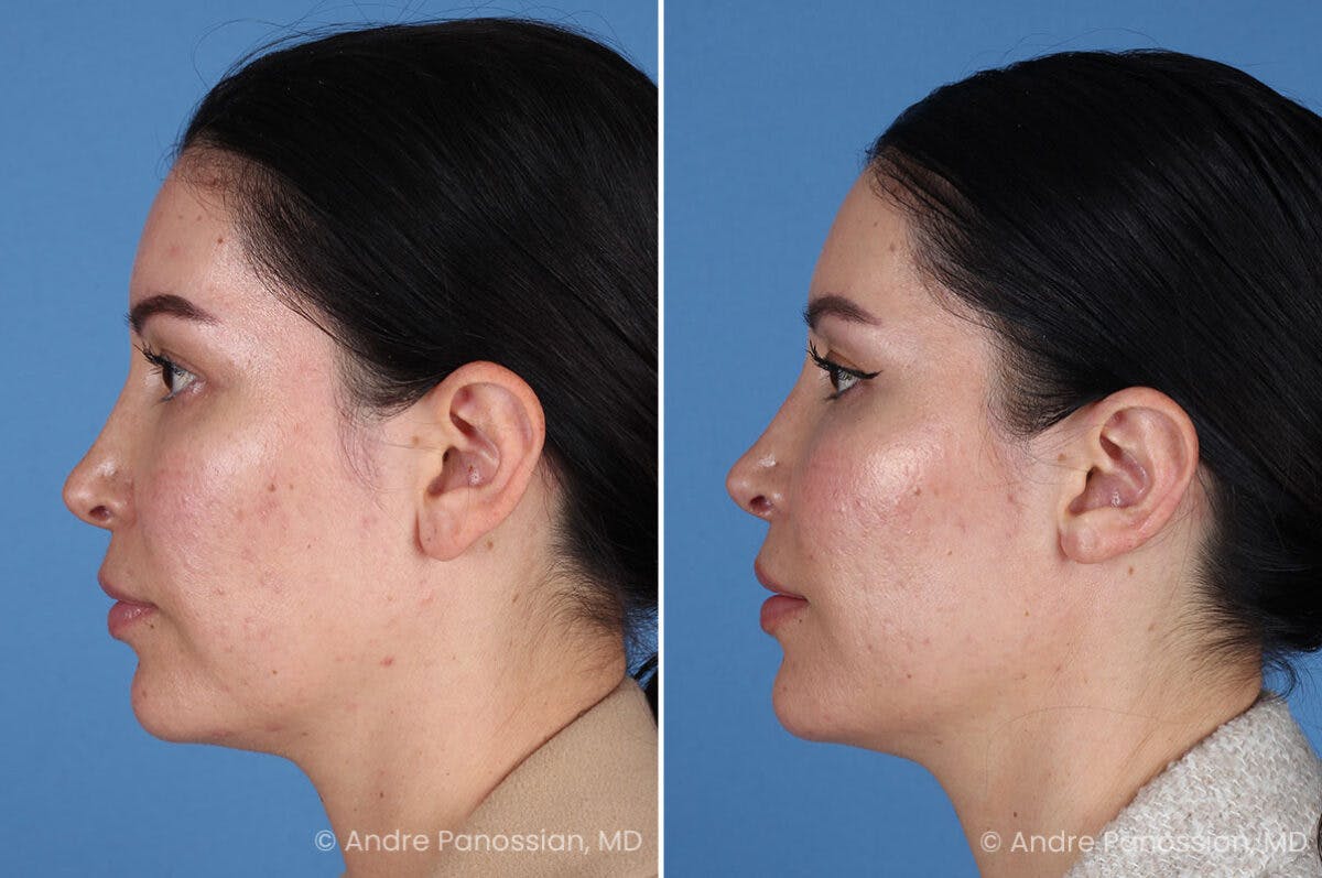 Ear Pinning (Otoplasty) Before & After Gallery - Patient 227974 - Image 5