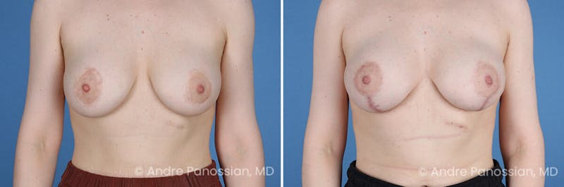 Breast Lift/Reduction Before & After Gallery - Patient 994137 - Image 1