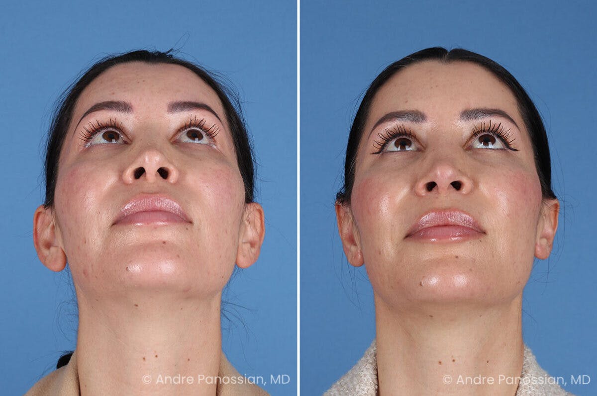 Ear Pinning (Otoplasty) Before & After Gallery - Patient 227974 - Image 6