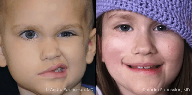 Smile Reanimation Before & After Gallery - Patient 243690 - Image 1