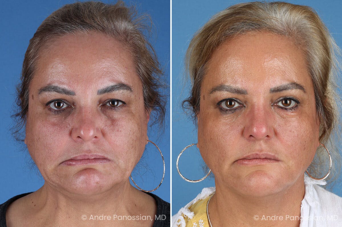 Selective Neurolysis Before & After Gallery - Patient 341804 - Image 1