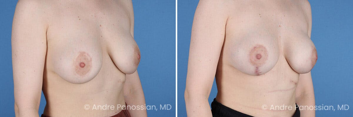 Breast Lift/Reduction Before & After Gallery - Patient 994137 - Image 2
