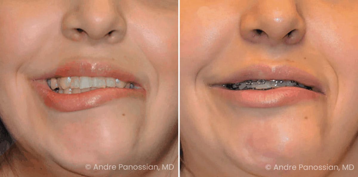 Symmetry Procedures Before & After Gallery - Patient 372823 - Image 1