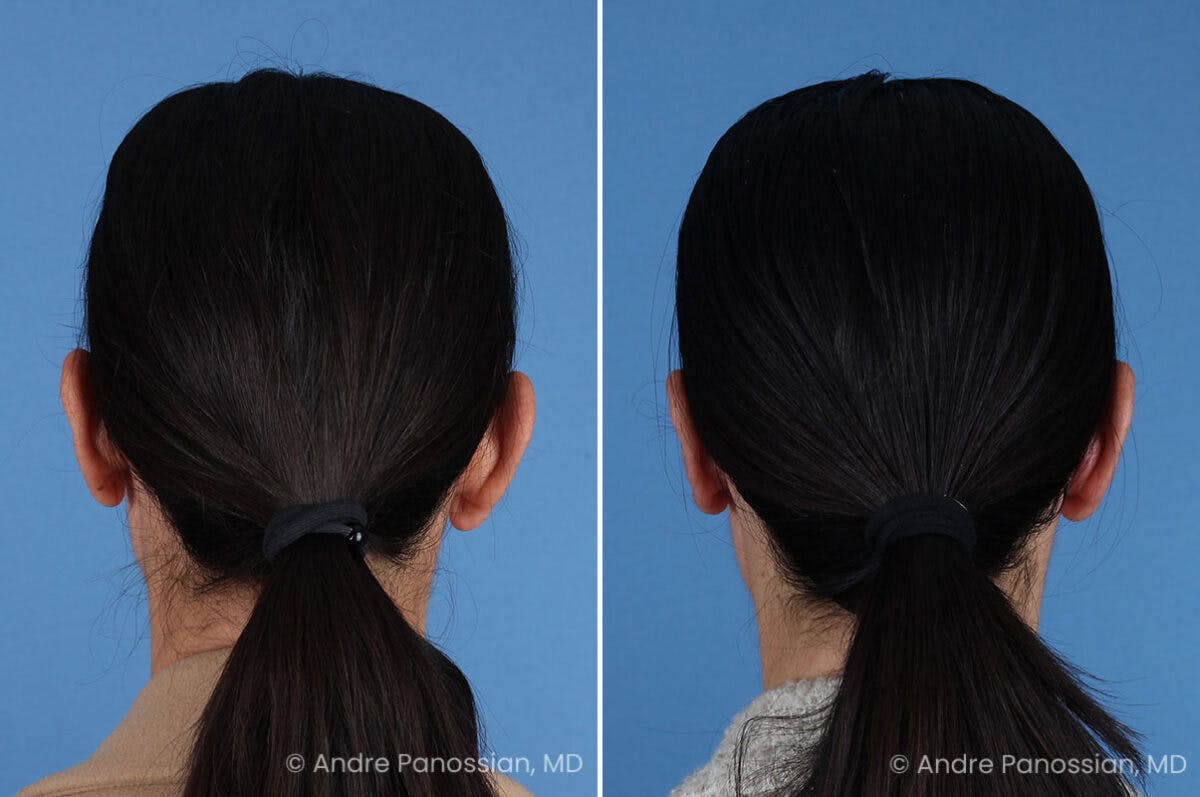Ear Pinning (Otoplasty) Before & After Gallery - Patient 227974 - Image 7