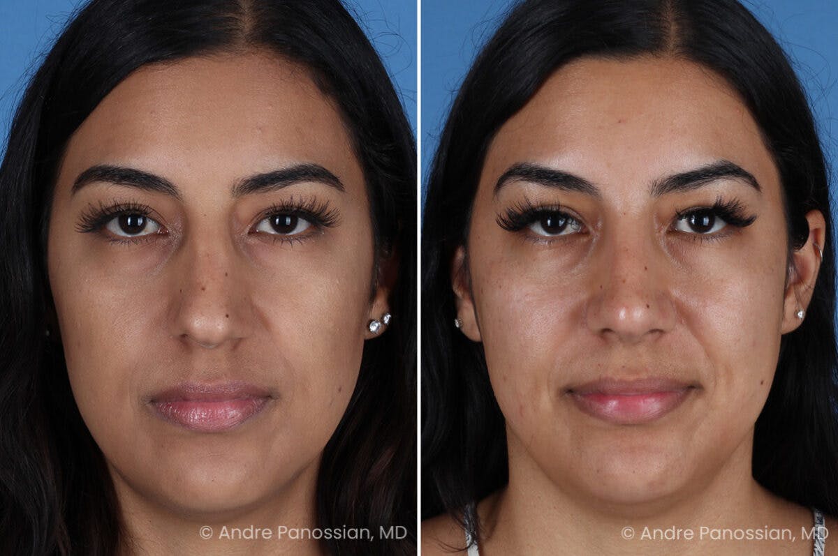 Rhinoplasty Before & After Gallery - Patient 331502 - Image 2