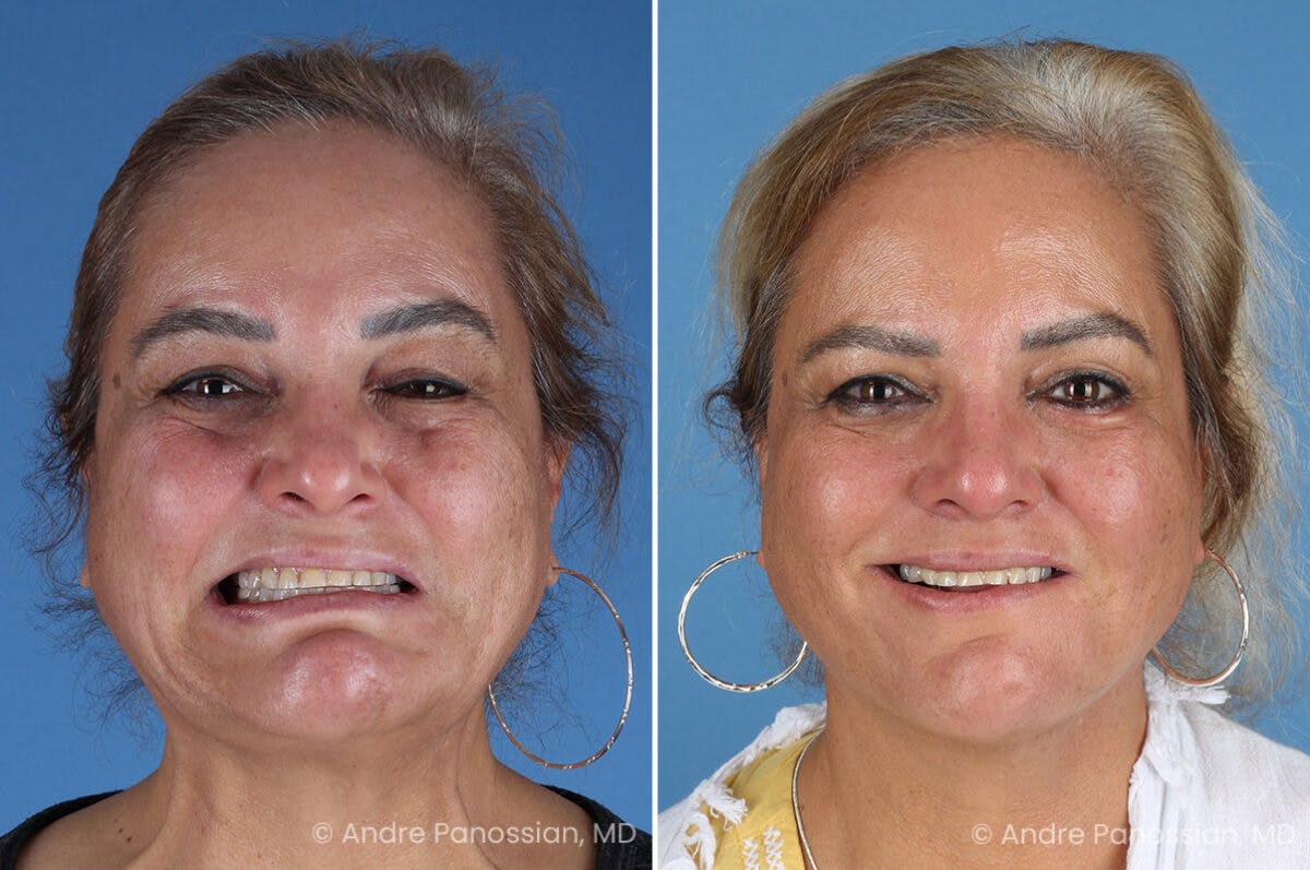 Selective Neurolysis Before & After Gallery - Patient 341804 - Image 2
