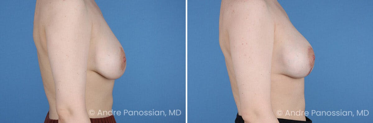Breast Lift/Reduction Before & After Gallery - Patient 994137 - Image 3