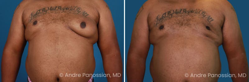 Male Breast Reduction (Gynecomastia) Before & After Gallery - Patient 934249 - Image 1