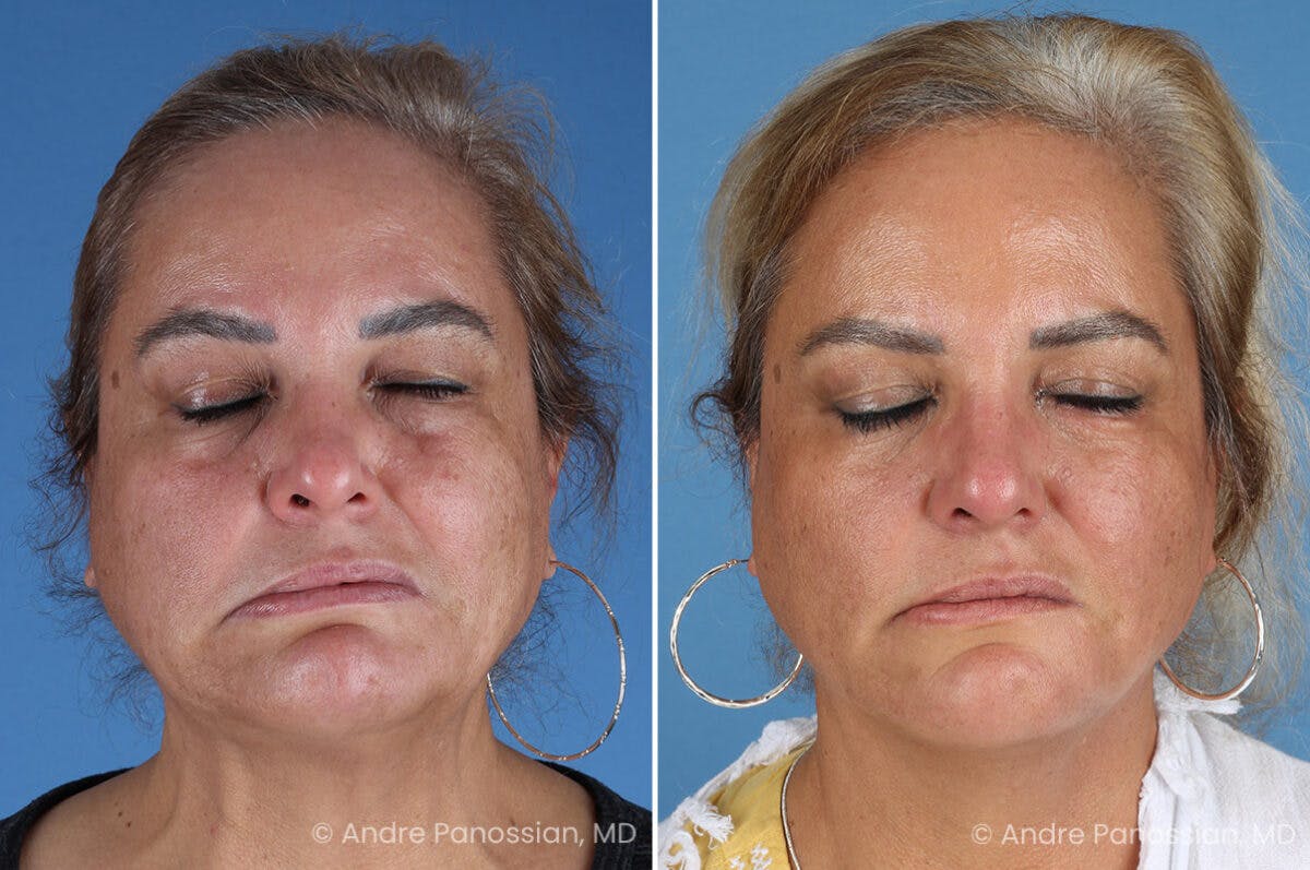 Selective Neurolysis Before & After Gallery - Patient 341804 - Image 3