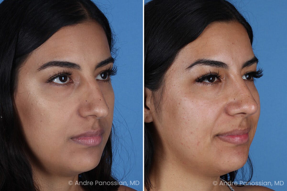 Rhinoplasty Before & After Gallery - Patient 331502 - Image 3