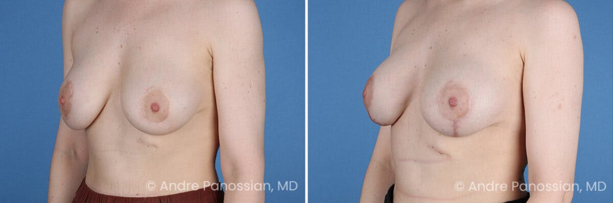 Breast Lift/Reduction Before & After Gallery - Patient 994137 - Image 4