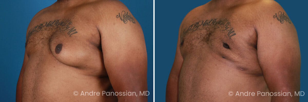 Male Breast Reduction (Gynecomastia) Before & After Gallery - Patient 934249 - Image 2