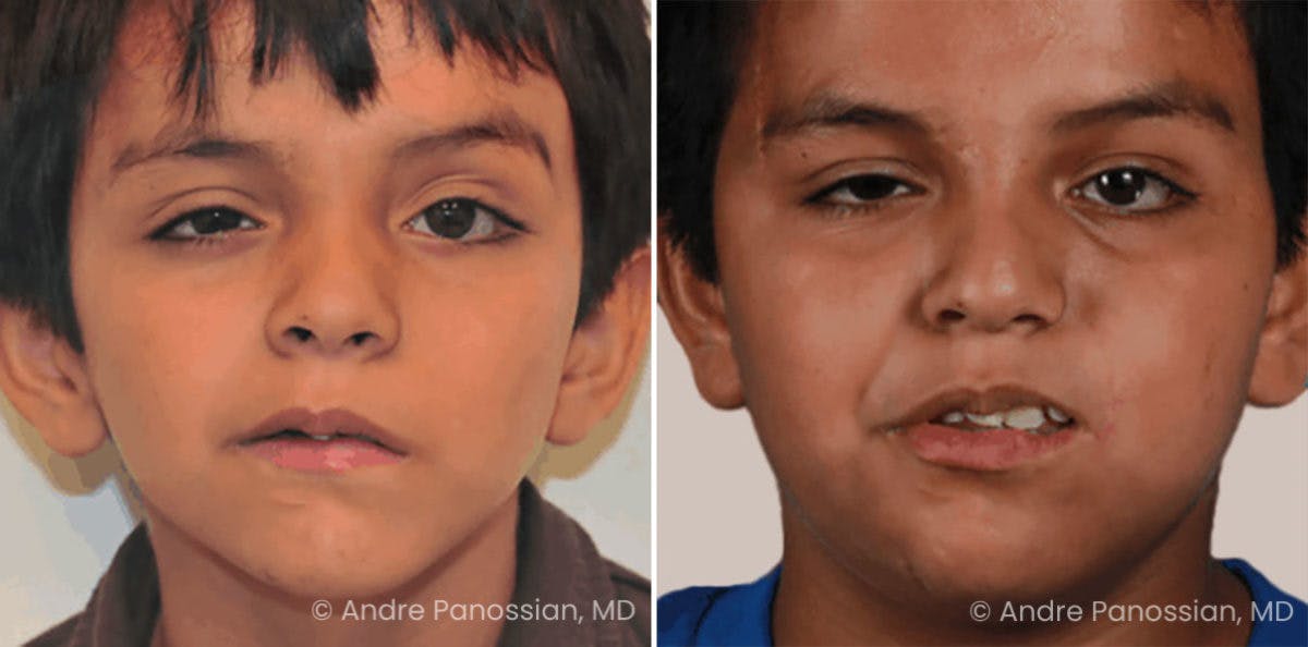 Smile Reanimation Before & After Gallery - Patient 726556 - Image 1