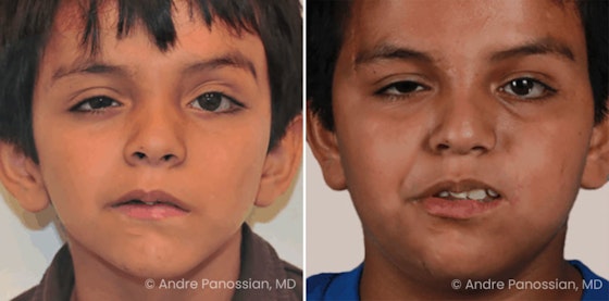 Facial reanimation — smile restoration before and after — actual patient of Andre Panossian, MD