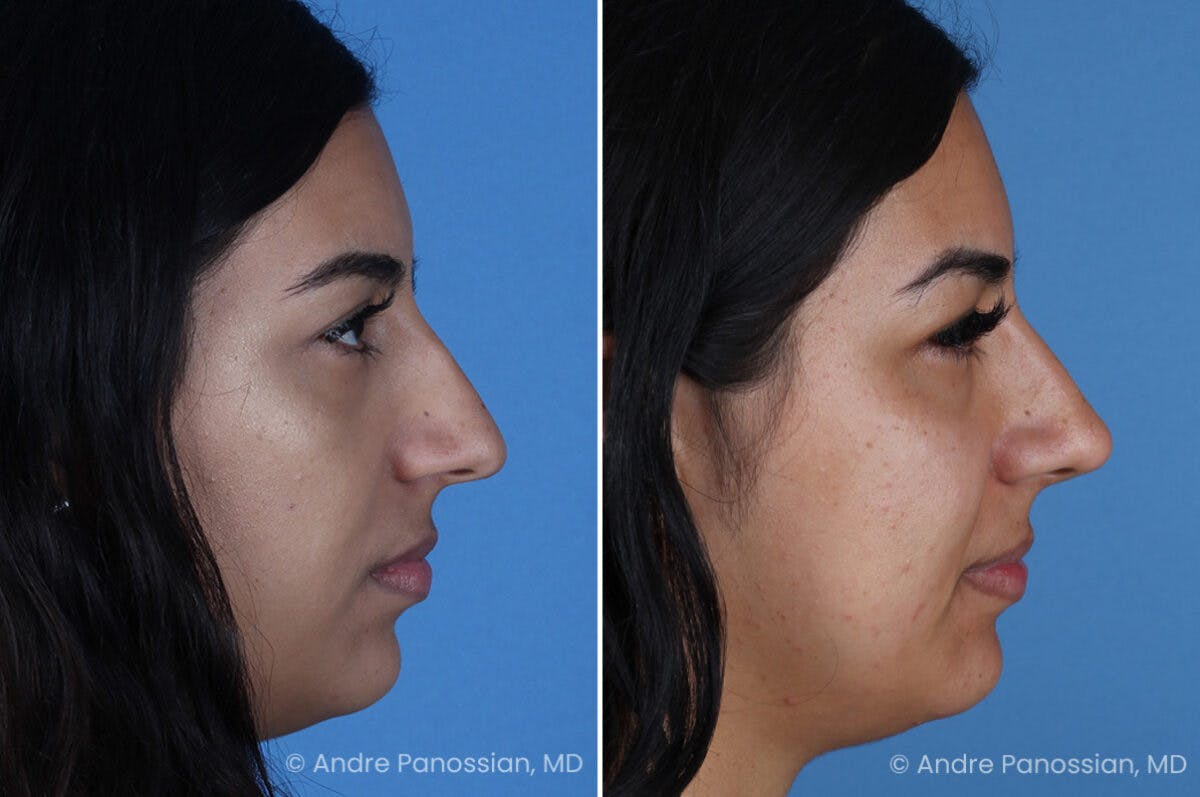 Rhinoplasty Before & After Gallery - Patient 331502 - Image 1