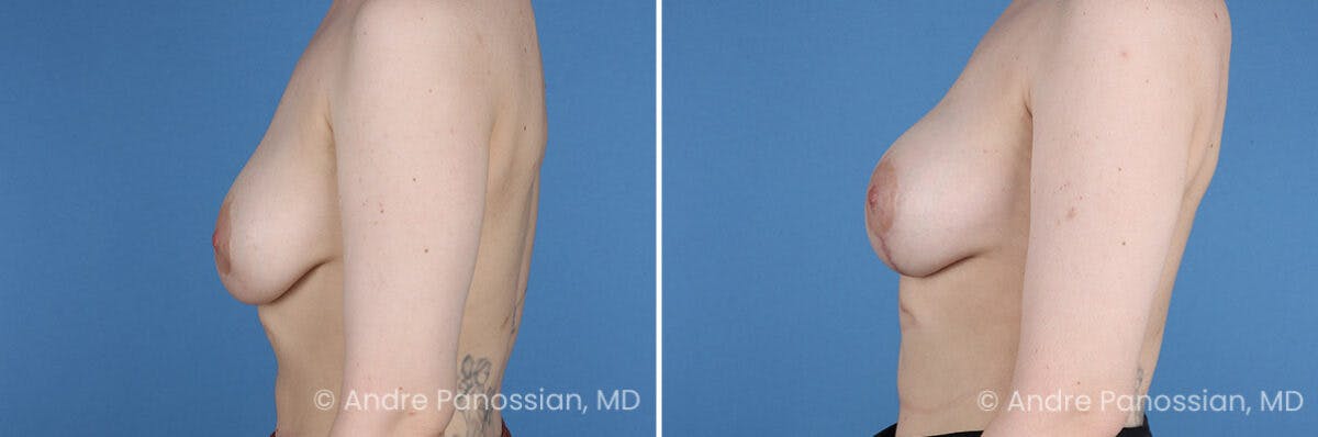 Breast Lift/Reduction Before & After Gallery - Patient 994137 - Image 5