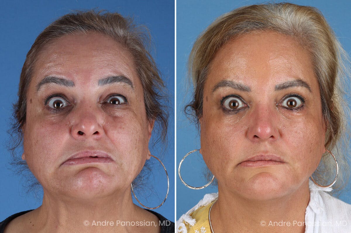 Selective Neurolysis Before & After Gallery - Patient 341804 - Image 4