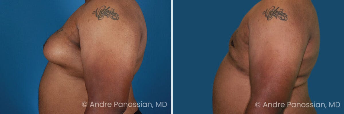 Male Breast Reduction (Gynecomastia) Before & After Gallery - Patient 934249 - Image 3