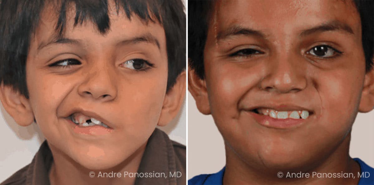 Smile Reanimation Before & After Gallery - Patient 726556 - Image 2