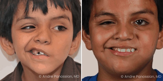 Facial reanimation — smile restoration before and after — actual patient of Andre Panossian, MD