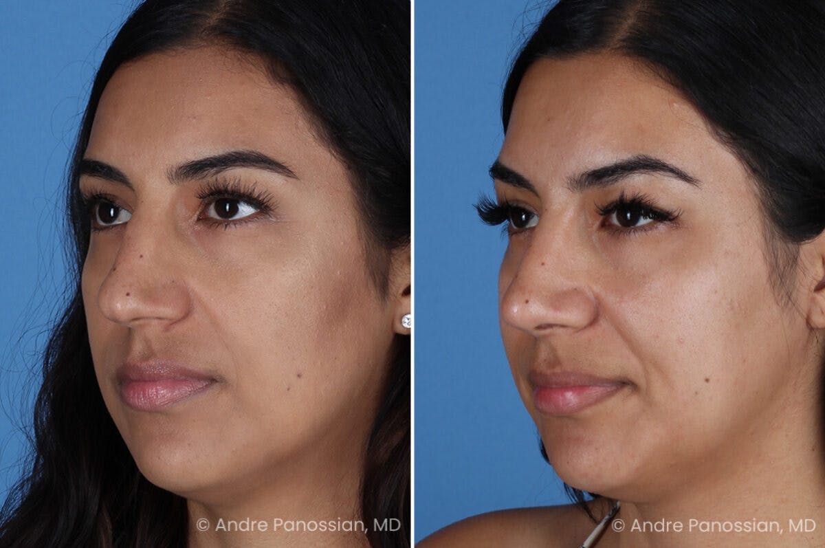Rhinoplasty Before & After Gallery - Patient 331502 - Image 4