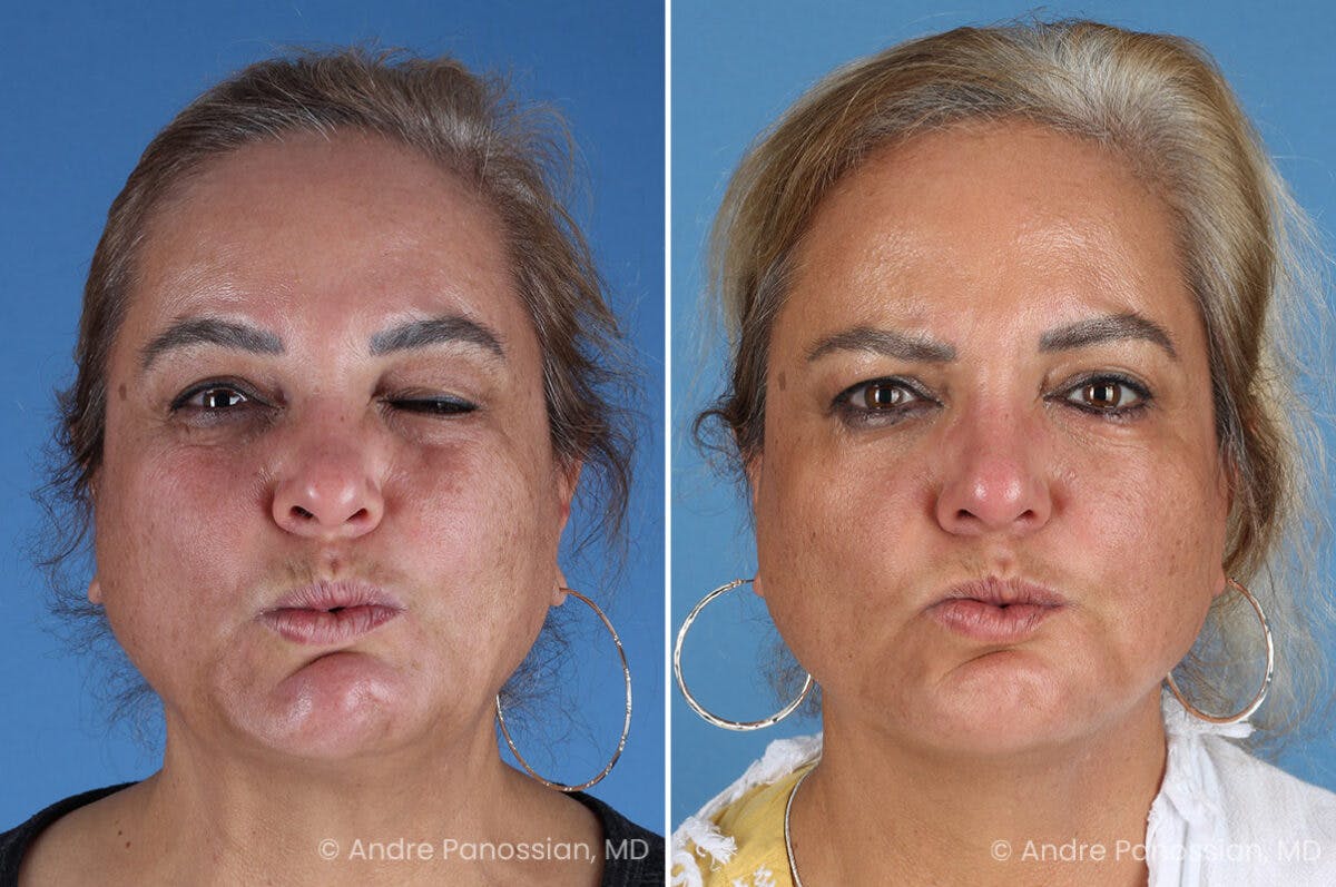 Selective Neurolysis Before & After Gallery - Patient 341804 - Image 5