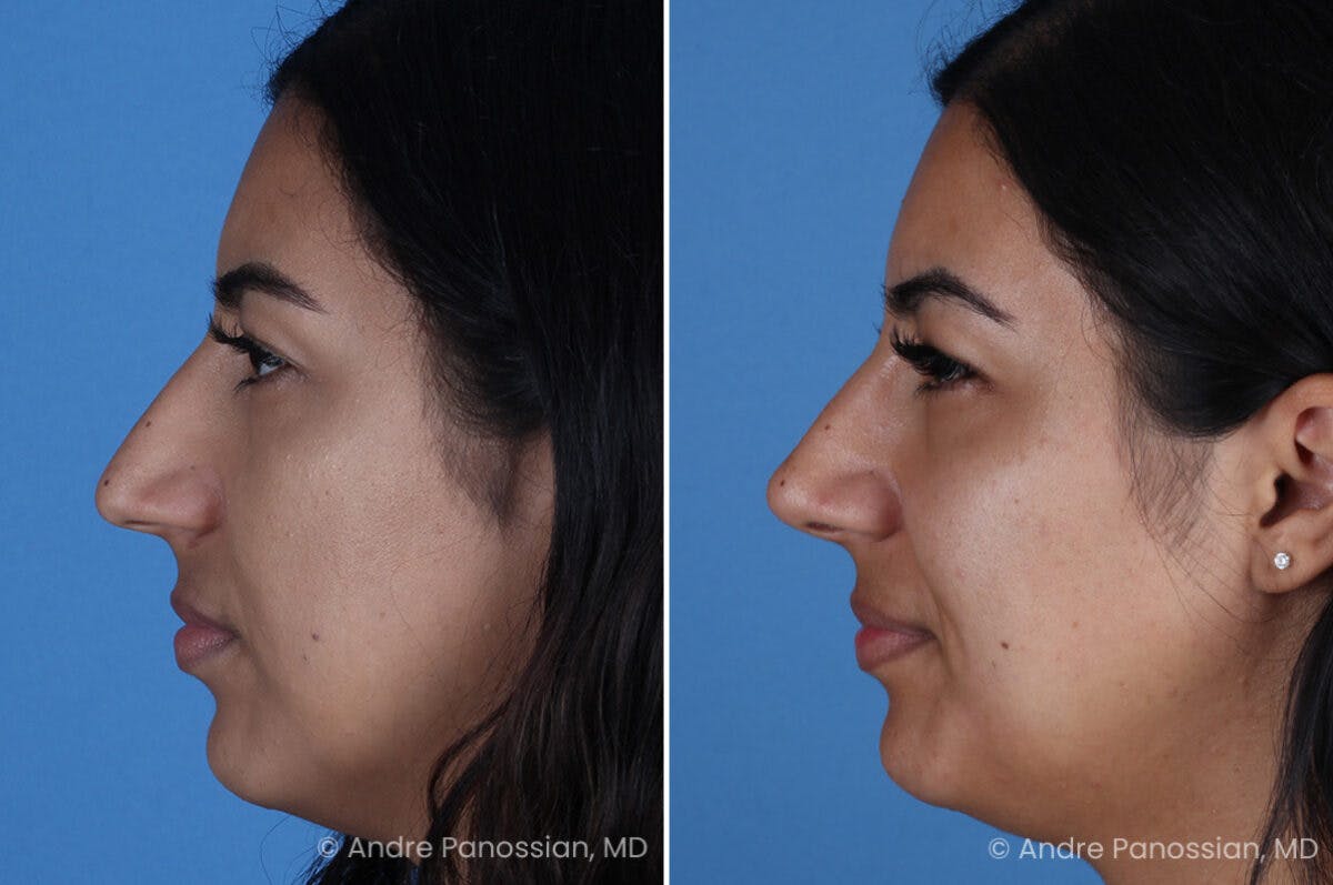 Rhinoplasty Before & After Gallery - Patient 331502 - Image 5