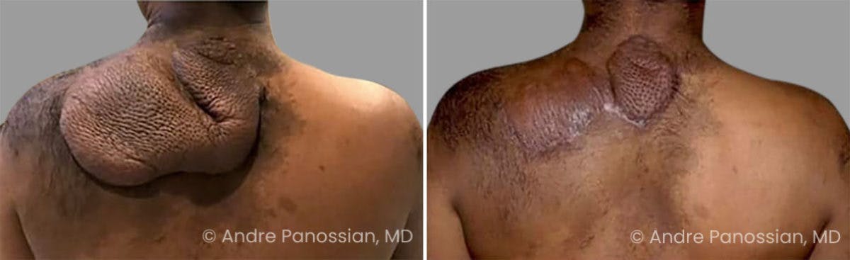 Neurofibromatosis Before & After Gallery - Patient 121456 - Image 1