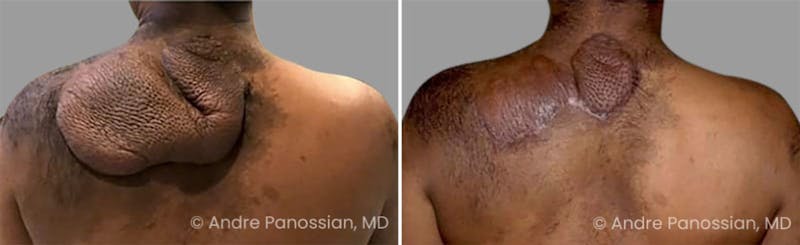 Neurofibromatosis Before & After Gallery - Patient 121456 - Image 1