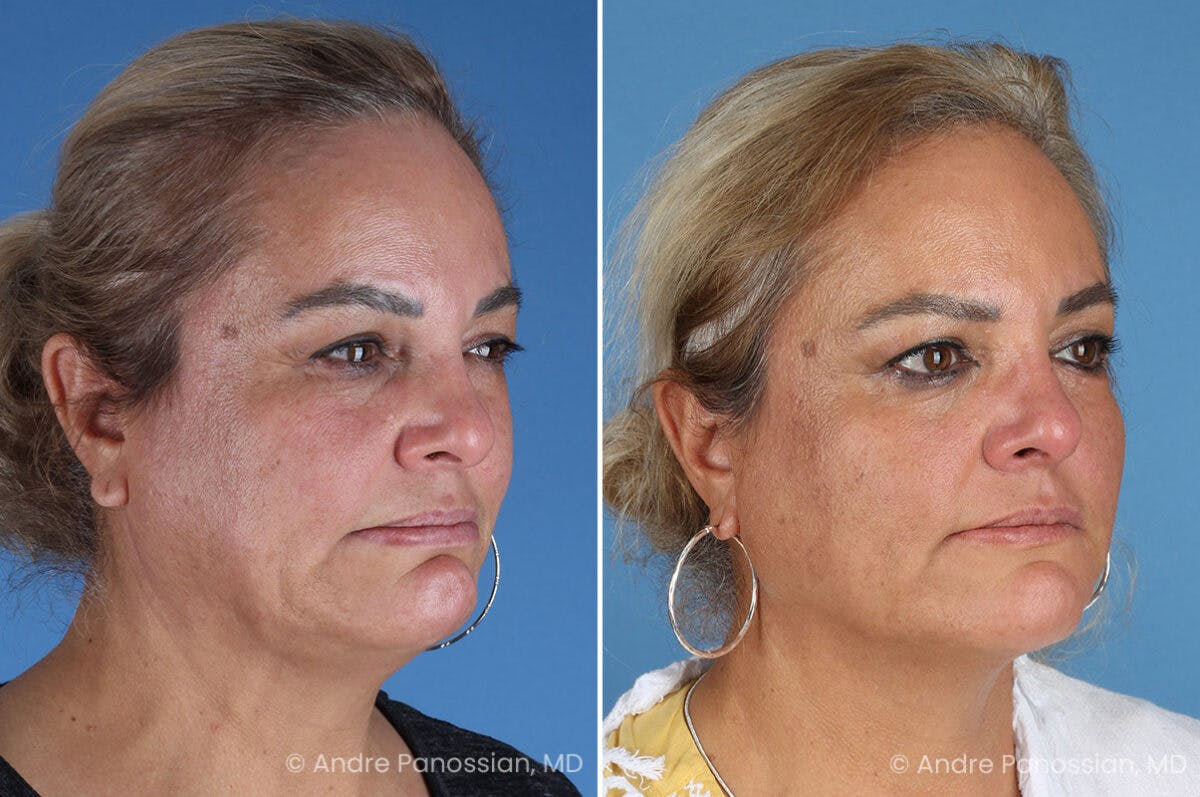 Selective Neurolysis Before & After Gallery - Patient 341804 - Image 6