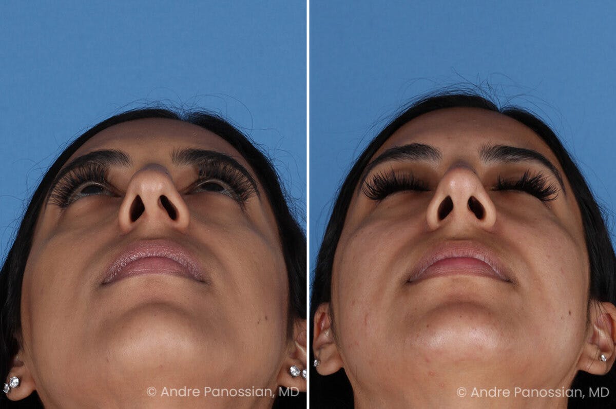 Rhinoplasty Before & After Gallery - Patient 331502 - Image 6
