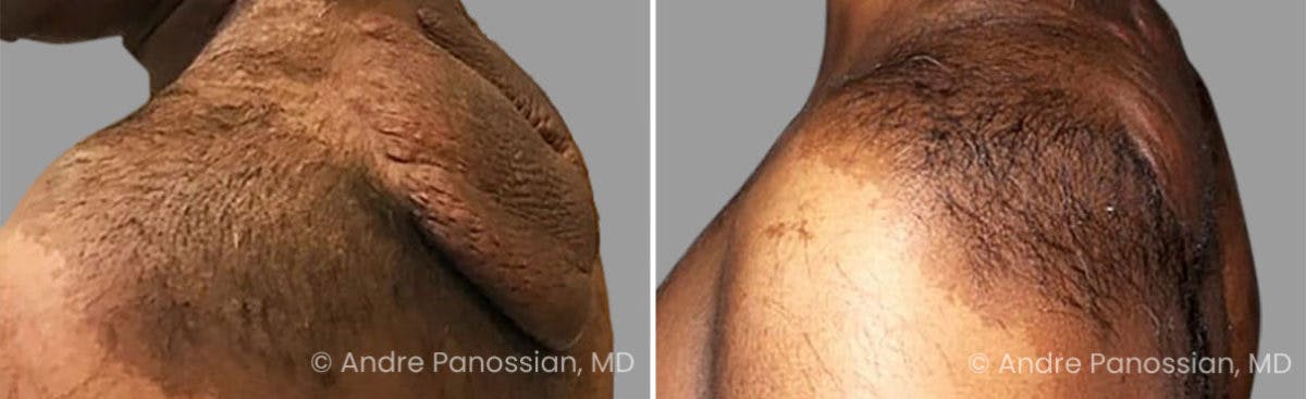 Neurofibromatosis Before & After Gallery - Patient 121456 - Image 2
