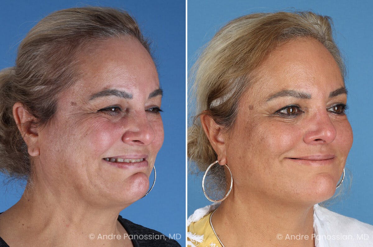 Selective Neurolysis Before & After Gallery - Patient 341804 - Image 7