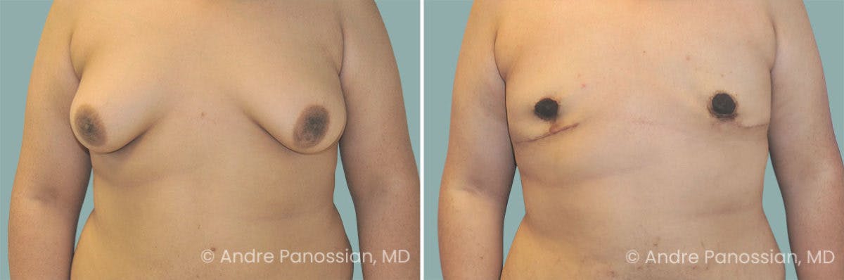 Male Breast Reduction (Gynecomastia) Before & After Gallery - Patient 155275 - Image 1