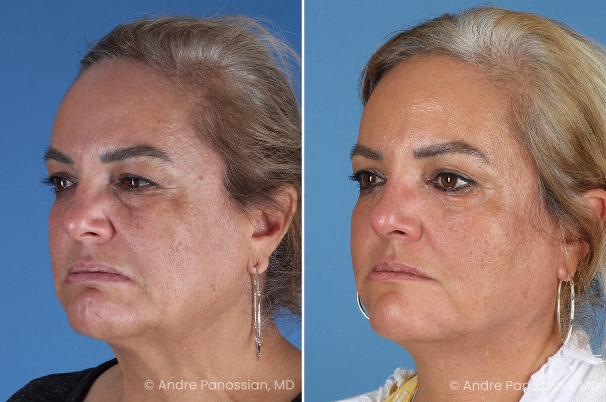 Selective Neurolysis Before & After Gallery - Patient 341804 - Image 8