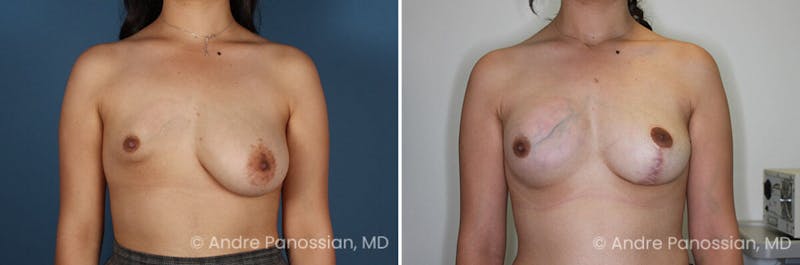 Breast Lift/Reduction Before & After Gallery - Patient 112349 - Image 1