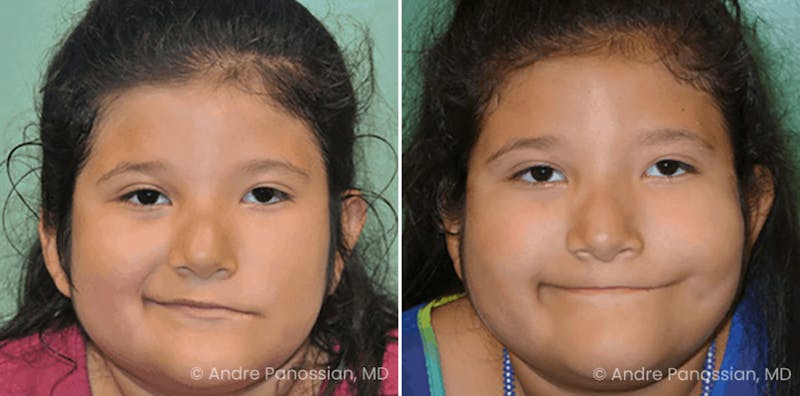 Smile Reanimation Before & After Gallery - Patient 157359 - Image 1