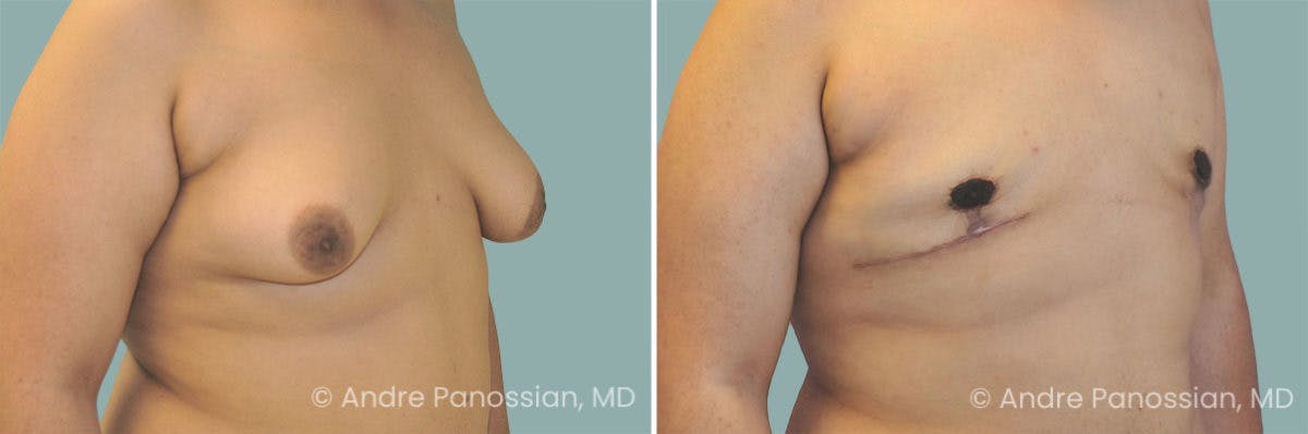 Male Breast Reduction (Gynecomastia) Before & After Gallery - Patient 155275 - Image 2