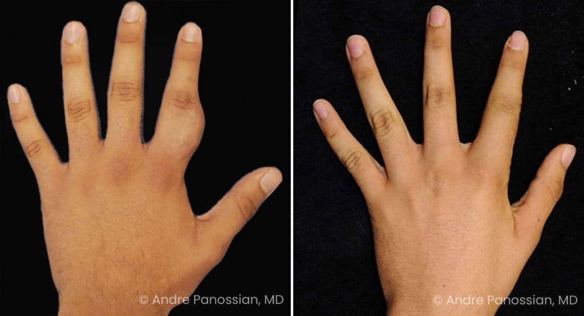 Neurofibromatosis Before & After Gallery - Patient 610721 - Image 1