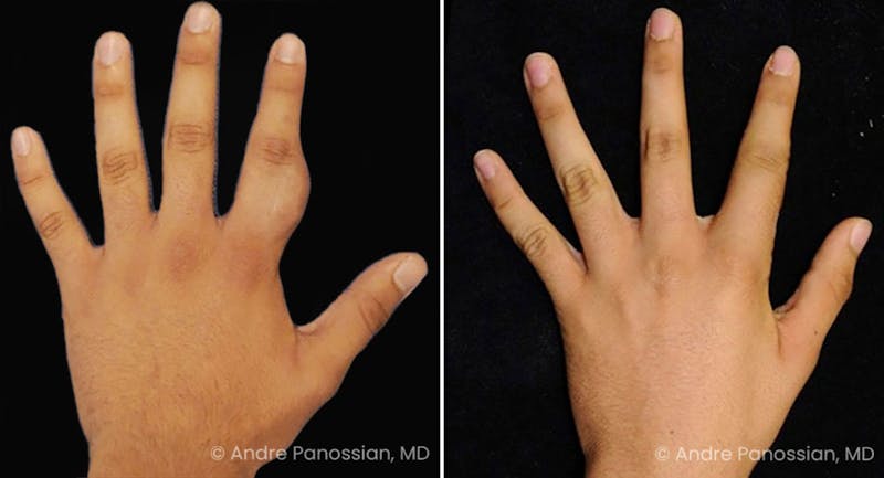 Neurofibromatosis Before & After Gallery - Patient 610721 - Image 1