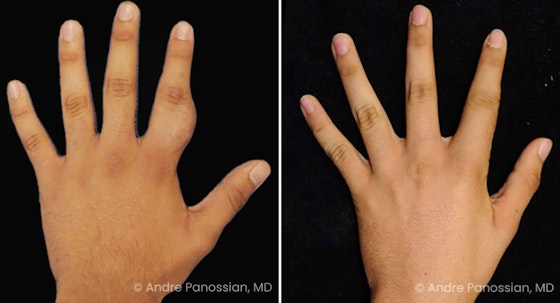Neurofibroma removal & reconstruction before and after — actual patient of Andre Panossian, MD