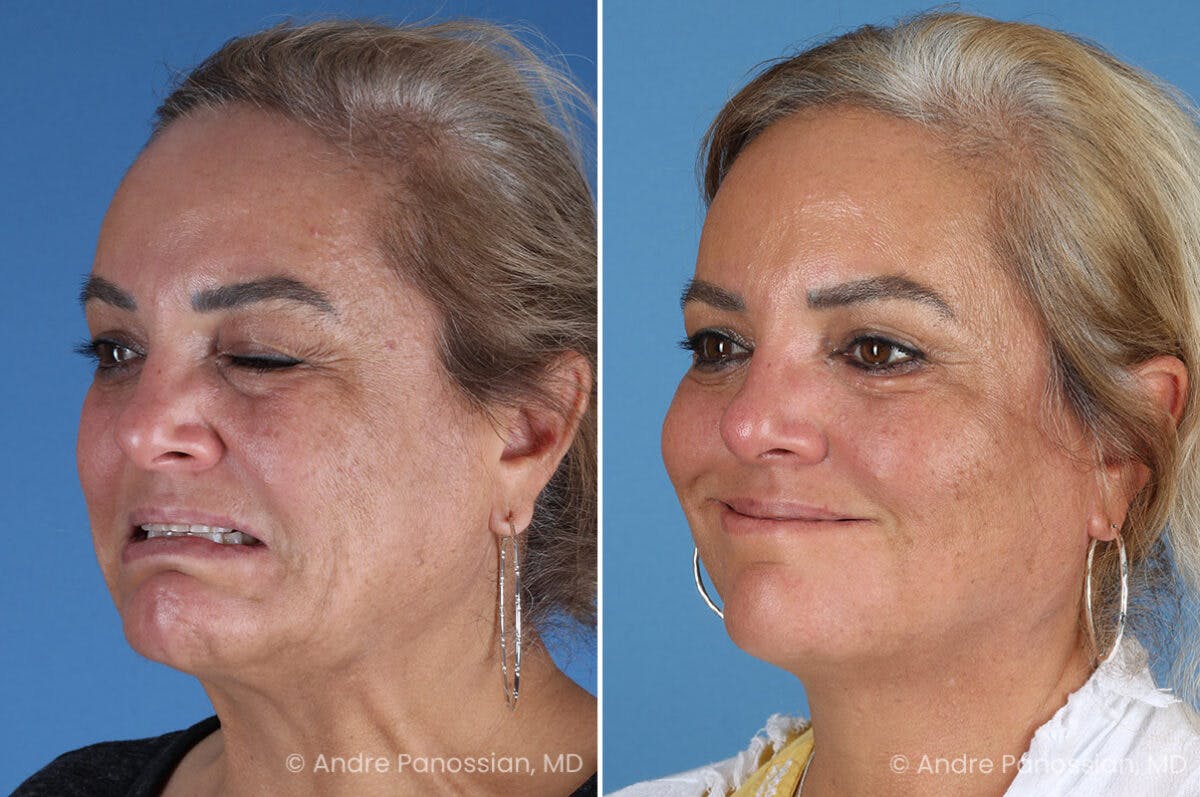 Selective Neurolysis Before & After Gallery - Patient 341804 - Image 9