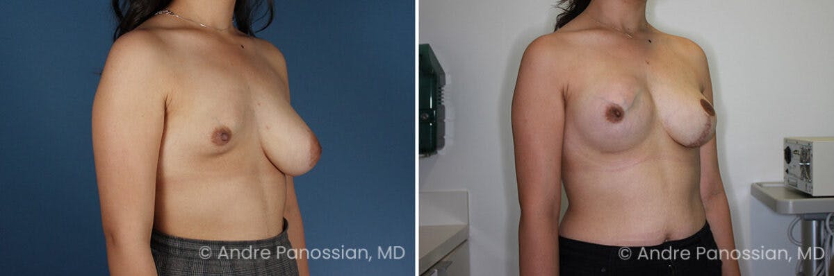 Breast Lift/Reduction Before & After Gallery - Patient 112349 - Image 2