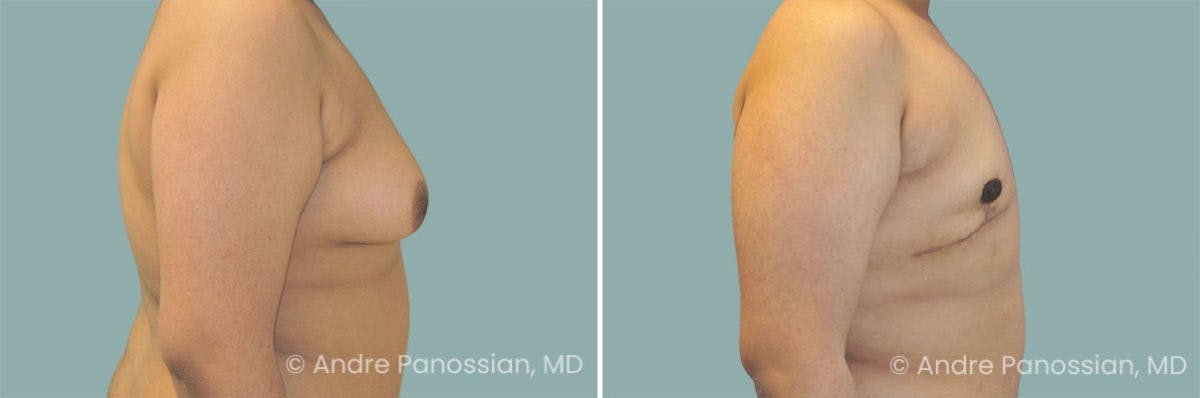 Male Breast Reduction (Gynecomastia) Before & After Gallery - Patient 155275 - Image 3