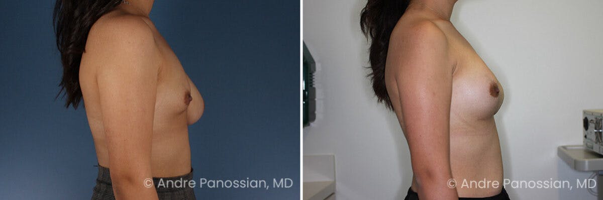 Breast Lift/Reduction Before & After Gallery - Patient 112349 - Image 3