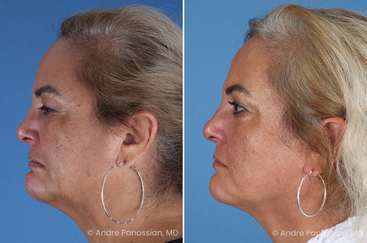 Selective Neurolysis Before & After Gallery - Patient 341804 - Image 10
